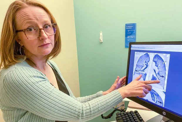 Heather De Keyser, a pediatric pulmonologist at Children's Hospital Colorado, points to the X-ray of a lung of a young adult damaged by vaping. (John Daley/Colorado Public Radio/TNS)